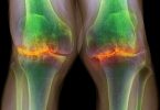 Електричні імпланти в колінах